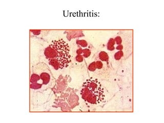 Urethritis:
 