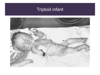 Triploid infant
 