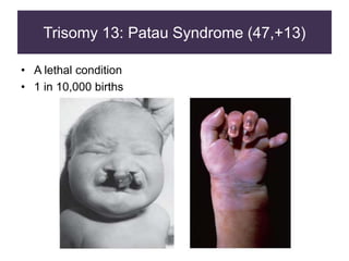 Trisomy 13: Patau Syndrome (47,+13)
• A lethal condition
• 1 in 10,000 births
 