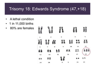 Trisomy 18: Edwards Syndrome (47,+18)
• A lethal condition
• 1 in 11,000 births
• 80% are females
 