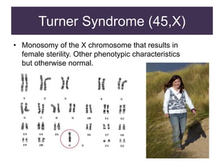 Turner Syndrome (45,X)
• Monosomy of the X chromosome that results in
female sterility. Other phenotypic characteristics
but otherwise normal.
 