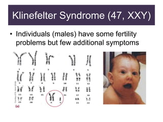 Klinefelter Syndrome (47, XXY)
• Individuals (males) have some fertility
problems but few additional symptoms
 