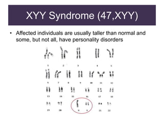 XYY Syndrome (47,XYY)
• Affected individuals are usually taller than normal and
some, but not all, have personality disorders
 