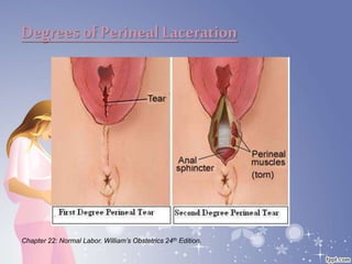Degreesof Perineal Laceration
Chapter 22: Normal Labor. William’s Obstetrics 24th Edition.
 