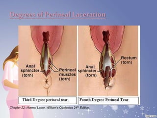 Degreesof Perineal Laceration
Chapter 22: Normal Labor. William’s Obstetrics 24th Edition.
 