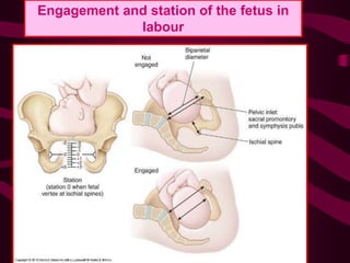 Engagement and station of the fetus in
labour
 