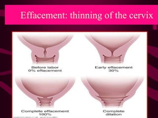 Effacement: thinning of the cervix
 