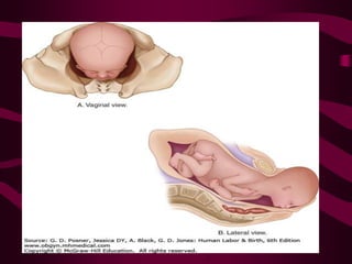 Fetal attitude or posture
 The fetus becomes folded upon itself:
 the back becomes markedly convex,
 the head is sharpl...