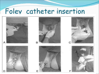 Foley  catheter insertion 