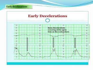 Early decelerations
 