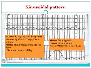 •A smooth, regular, wave-like pattern
•Frequency of around 2-5 cycles a
minute
•Stable baseline rate around 120-160
bpm
•No beat to beat variability
•Severe foetal hypoxia
•Severe foetal anaemia
•Foetal/Maternal Haemorrhage
 