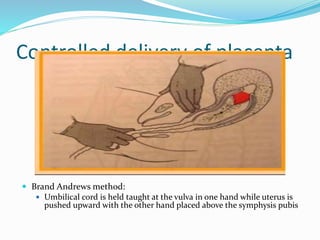 Controlled delivery of placenta
 Brand Andrews method:
 Umbilical cord is held taught at the vulva in one hand while
uterus is pushed upward with the other hand placed above
the symphysis pubis
 
