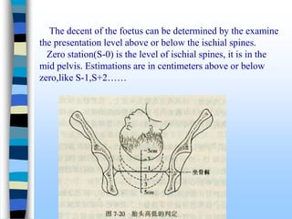 The decent of the foetus can be determined by the examine
the presentation level above or below the ischial spines.
Zero station(S-0) is the level of ischial spines, it is in the
mid pelvis. Estimations are in centimeters above or below
zero,like S-1,S+2……
 