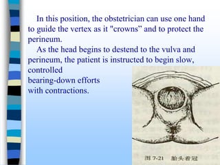 In this position, the obstetrician can use one hand
to guide the vertex as it "crowns” and to protect the
perineum.
As the head begins to destend to the vulva and
perineum, the patient is instructed to begin slow,
controlled
bearing-down efforts
with contractions.
 