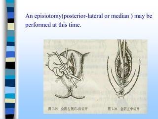 An episiotomy(posterior-lateral or median ) may be
performed at this time.
 