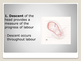 1. Descent of the
head provides a
measure of the
progress of labour
 Descent occurs
throughout labour
 