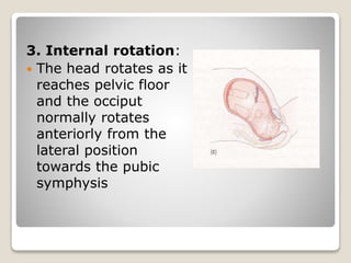 3. Internal rotation:
 The head rotates as it
reaches pelvic floor
and the occiput
normally rotates
anteriorly from the
lateral position
towards the pubic
symphysis
 