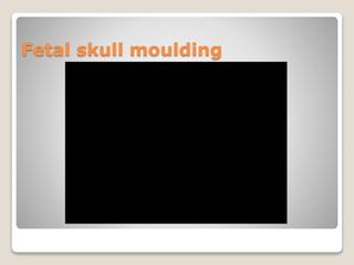 Fetal skull moulding
 