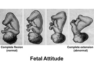 Fetal Attitude 10
Complete extension
(abnormal)
Complete flexion
(normal)
 