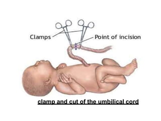 34
clamp and cut of the umbilical cord
 