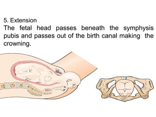 5. Extension
The fetal head passes beneath the symphysis
pubis and passes out of the birth canal making the
crowning.
23
 