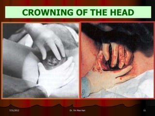 CROWNING OF THE HEAD




7/31/2012           Dr. Yin Moe Han   11
 