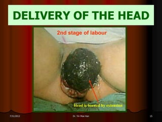 DELIVERY OF THE HEAD
            2nd stage of labour




                  Head is borned by extension

7/31/2012         Dr. Yin Moe Han               15
 