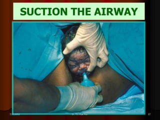 SUCTION THE AIRWAY




7/31/2012          Dr. Yin Moe Han   17
 