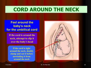 CORD AROUND THE NECK

    Feel around the
      baby’s neck
 for the umbilical cord
     If the cord is around the
      neck, attempt to slip it
       over the baby’s head

          If the cord is tight
      around the neck, doubly
       clamp and cut it before
          unwinding it from
           around the neck

7/31/2012                        Dr. Yin Moe Han   18
 