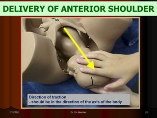 DELIVERY OF ANTERIOR SHOULDER




             Direction of traction
             - should be in the direction of the axis of the body

 7/31/2012                          Dr. Yin Moe Han                 22
 