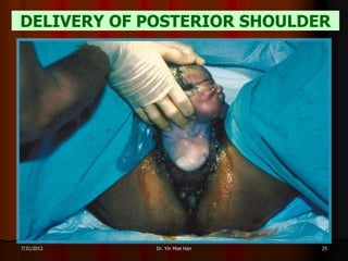 DELIVERY OF POSTERIOR SHOULDER




7/31/2012    Dr. Yin Moe Han   25
 