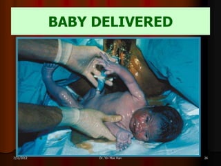BABY DELIVERED




7/31/2012        Dr. Yin Moe Han   26
 