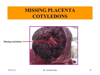 MISSING PLACENTA
                       COTYLEDONS



Missing cotyledons




    07/31/12              Dr. Yin Moe Han   17
 