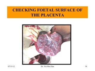 CHECKING FOETAL SURFACE OF
           THE PLACENTA




07/31/12       Dr. Yin Moe Han    18
 