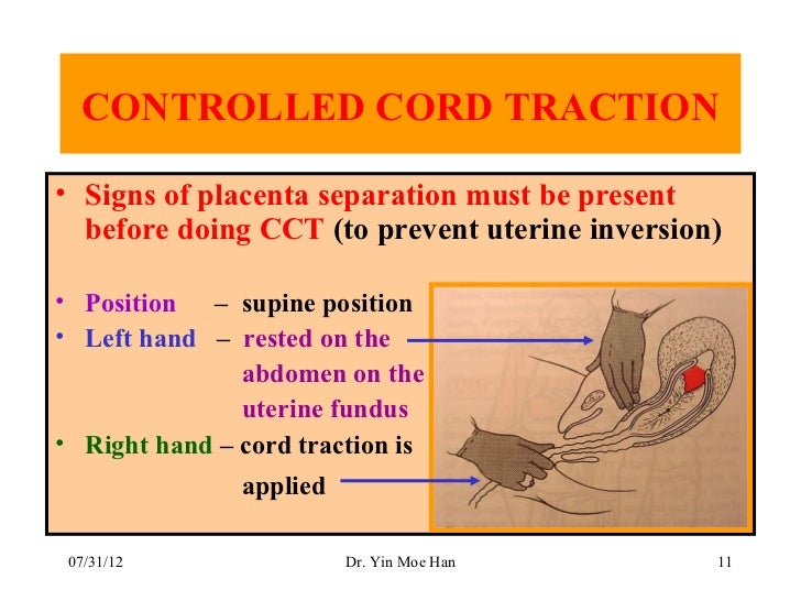 Normal labour, third stage by Dr Yin Moe