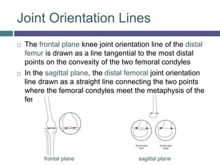 Joint Orientation Lines
 The frontal plane knee joint orientation line of the distal
femur is drawn as a line tangential to the most distal
points on the convexity of the two femoral condyles
 In the sagittal plane, the distal femoral joint orientation
line drawn as a straight line connecting the two points
where the femoral condyles meet the metaphysis of the
femur.
frontal plane sagittal plane
 