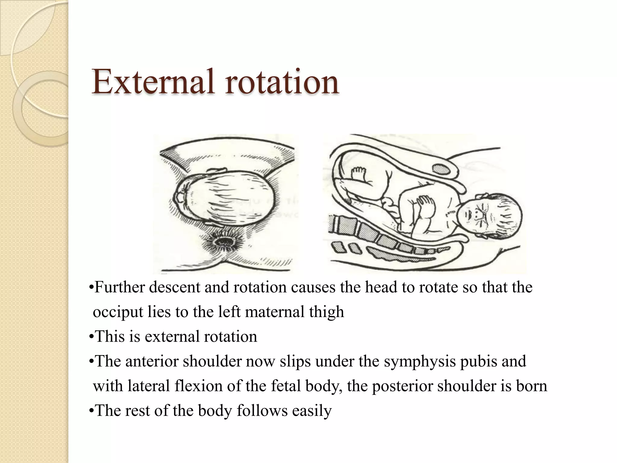External rotation
•Further descent and rotation causes the head to rotate so that the
occiput lies to the left maternal thigh
•This is external rotation
•The anterior shoulder now slips under the symphysis pubis and
with lateral flexion of the fetal body, the posterior shoulder is born
•The rest of the body follows easily