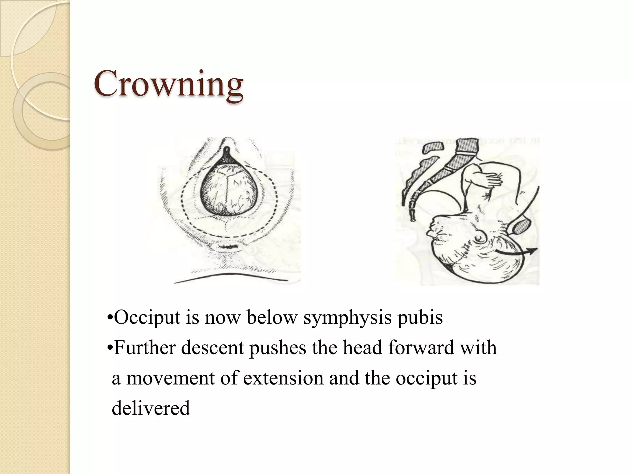Crowning
•Occiput is now below symphysis pubis
•Further descent pushes the head forward with
a movement of extension and the occiput is
delivered
