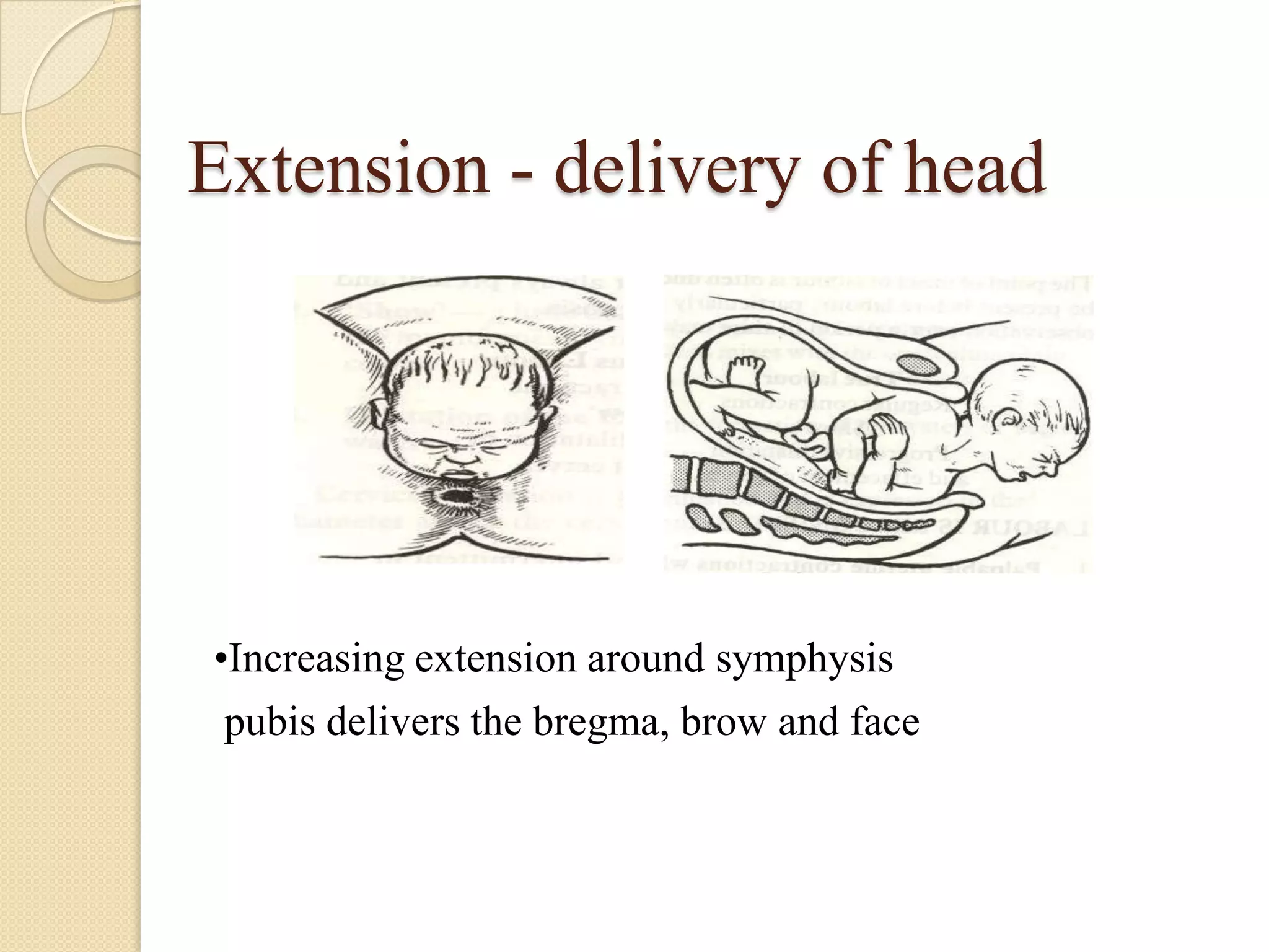 Extension - delivery of head
•Increasing extension around symphysis
pubis delivers the bregma, brow and face