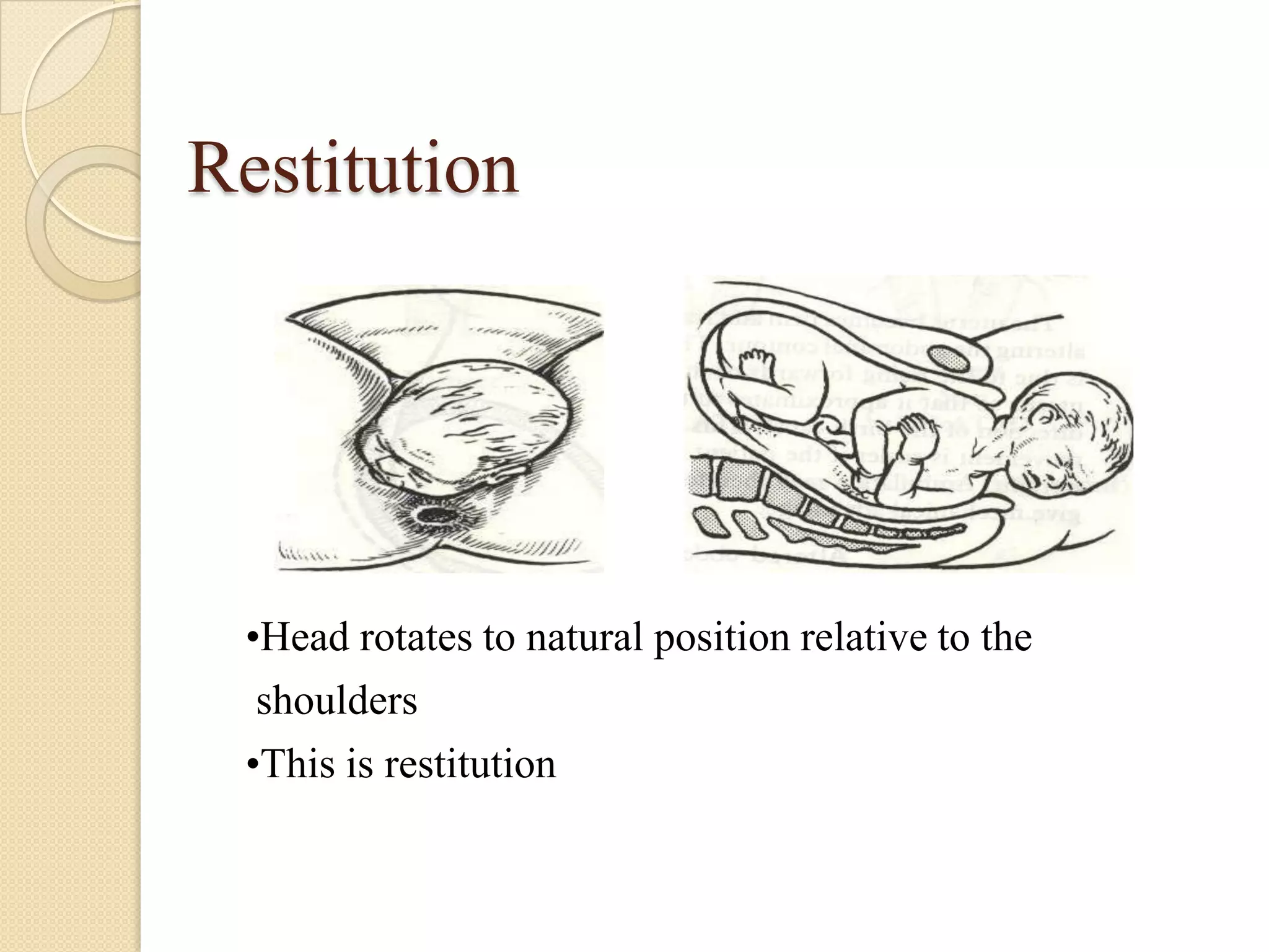 Restitution
•Head rotates to natural position relative to the
shoulders
•This is restitution