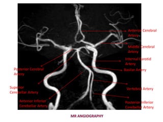 Internal Carotid
Artery
Basilar Artery
Vertebral Artery
Middle Cerebral
Artery
Anterior Cerebral
Artery
Posterior Cerebral
Artery
Posterior Inferior
Cerebellar Artery
Superior
Cerebellar Artery
Anterior Inferior
Cerebellar Artery
 