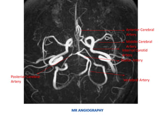 Vertebral Artery
Basilar Artery
Posterior Cerebral
Artery
Internal Carotid
Artery
Anterior Cerebral
Artery
Middle Cerebral
Artery
 