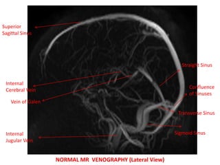 NORMAL MR VENOGRAPHY (Lateral View)
Superior
Sagittal Sinus
Internal
Jugular Vein
Sigmoid Sinus
Transverse Sinus
Confluence
of Sinuses
Straight Sinus
Vein of Galen
Internal
Cerebral Vein
 