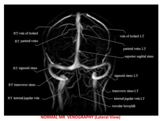 NORMAL MR VENOGRAPHY (Lateral View)
 