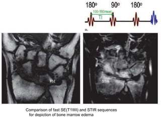 Comparison of fast SE(T1WI) and STIR sequences
for depiction of bone marrow edema
FSE STIR
 
