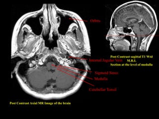 Post Contrast Axial MR Image of the brain
Post Contrast sagittal T1 Wtd
M.R.I.
Section at the level of medulla
Sigmoid Sinus
Medulla
Internal Jugular Vein
Cerebellar Tonsil
Orbits
 