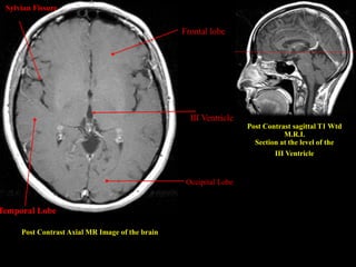 Post Contrast Axial MR Image of the brain
Post Contrast sagittal T1 Wtd
M.R.I.
Section at the level of the
III Ventricle
Occipital Lobe
III Ventricle
Frontal lobe
Temporal Lobe
Sylvian Fissure
 