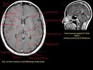 Fig. 1.6 Post Contrast Axial MR Image of the brain
Post Contrast sagittal T1 Wtd
M.R.I.
Section at the level of Thalamus
Superior Sagittal Sinus
Occipital Lobe
Choroid Plexus
. Internal Cerebral Vein
Frontal Horn
Thalamus
Temp Lobe
Internal Capsule
. Putamen
Caudate Nucleus
Frontal
Lobe
 