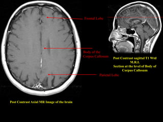 Post Contrast Axial MR Image of the brain
Post Contrast sagittal T1 Wtd
M.R.I.
Section at the level of Body of
Corpus Callosum
Parietal Lobe
Body of the
Corpus Callosum
Frontal Lobe
 