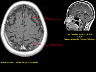 Post Contrast Axial MR Image of the brain
Post Contrast sagittal T1 Wtd
M.R.I.
Section above the Corpus Callosum
Parietal Lobe
Frontal Lobe
 